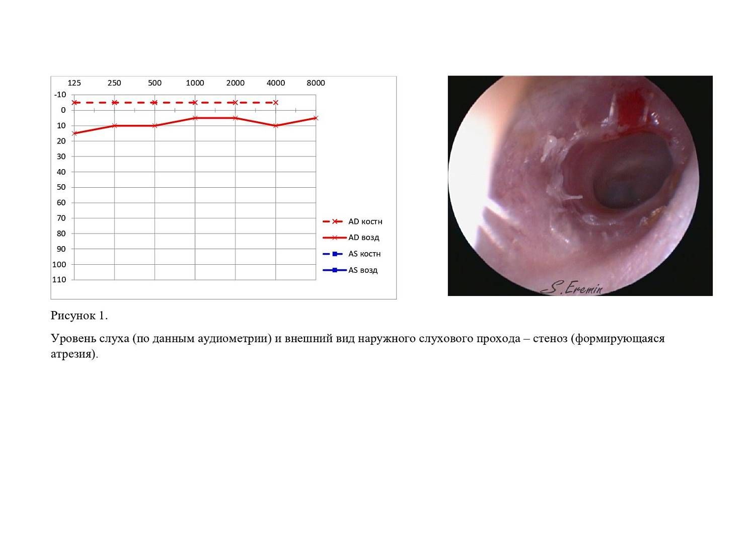 Уровень слуха (по данным аудиометрии) и внешний вид наружного слухового прохода – стеноз (формирующаяся атрезия). СПб НИИ ЛОР